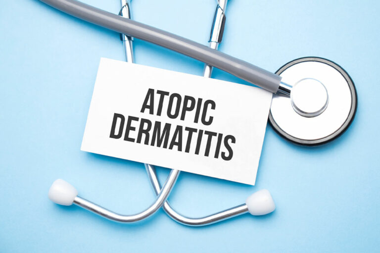 Atopic dermatitis &#8211; Symptoms and management tips